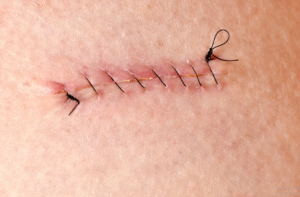 How to Know If You Need Stitches