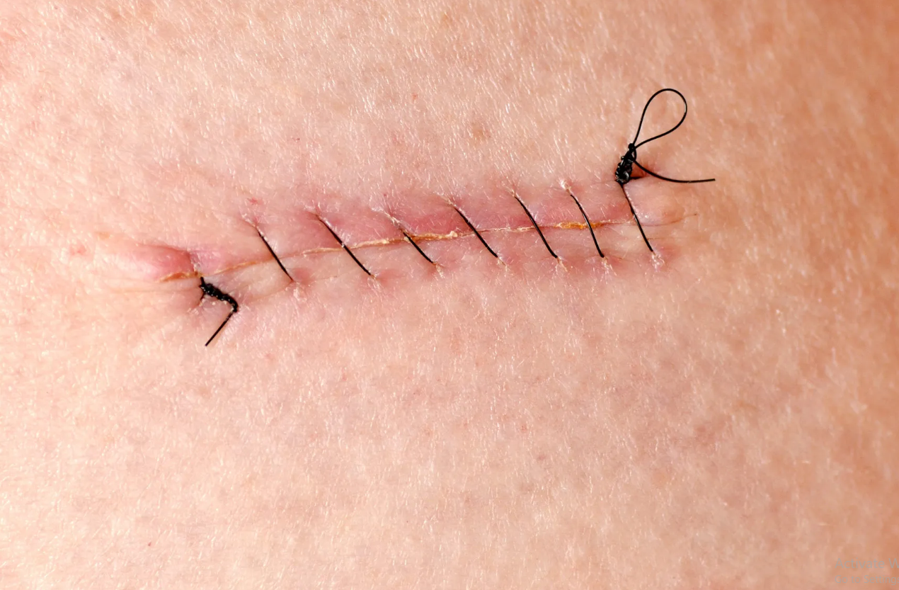 How to Know If You Need Stitches